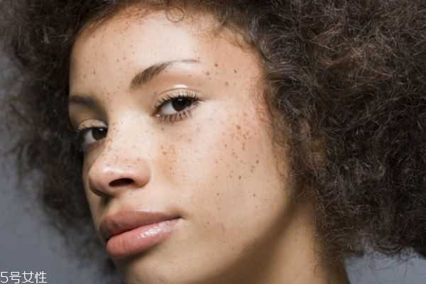 脸上的斑是怎么形成的