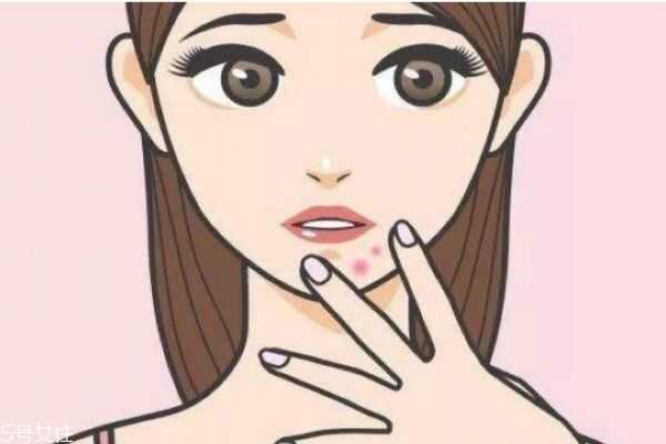怎样治疗下巴痘痘