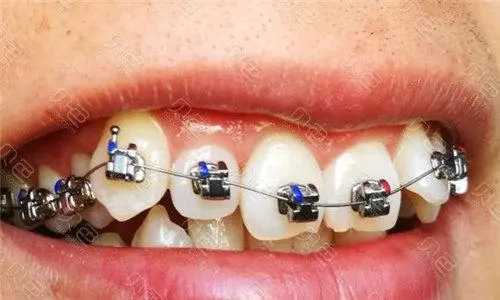 牙套价格一般是多少钱一个 牙套价格一般是多少钱一个