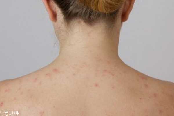 痘痘位置代表哪里不健康