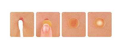 痘痘贴哪个牌子好？痘痘贴贴了有副作用吗