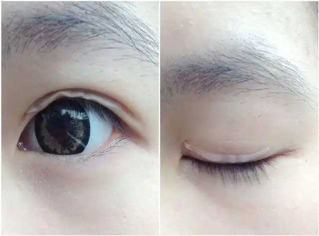 双眼皮贴有保质期吗 双眼皮贴有保质期吗