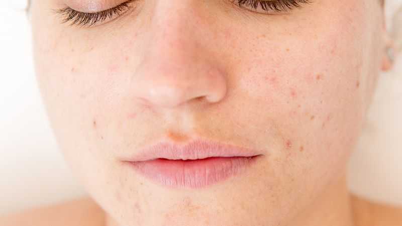 去黄褐斑面膜的使用方法 去黄褐斑面膜的使用方法