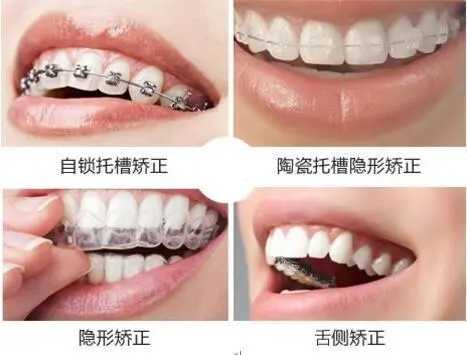牙齿矫正大概要花费多少钱