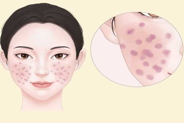 皮肤科医院哪家好?复旦大学附属华山医院排第一 皮肤科医院哪家好?复旦大学附属华山医院排第一