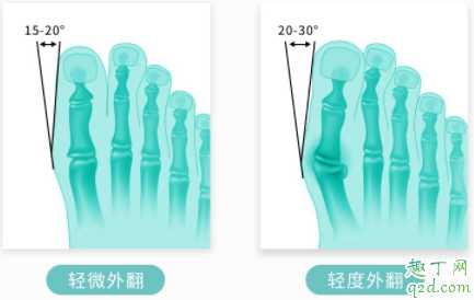 拇外翻矫正器有效果吗？拇外翻矫正器一天带多长时间
