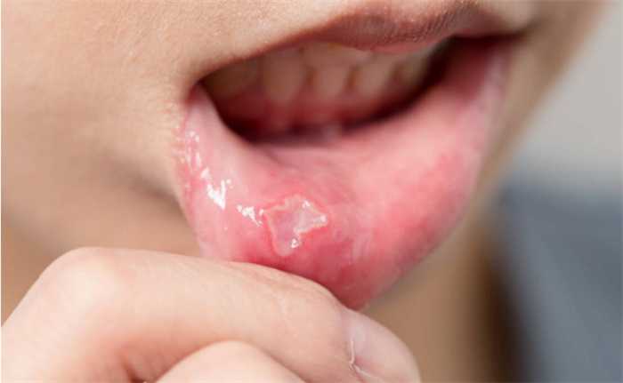 得了口腔溃疡怎么做才能好的快 得了口腔溃疡怎么做才能好的快