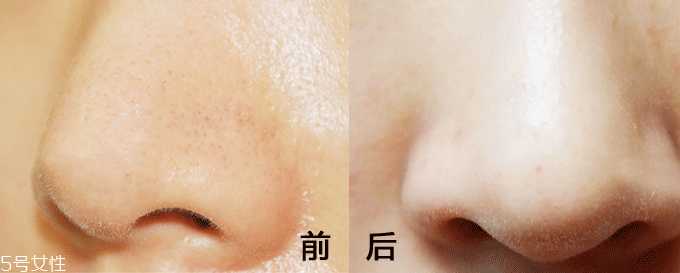 面膜什么成分能清洁毛孔