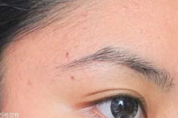 痘痘位置代表哪里不健康