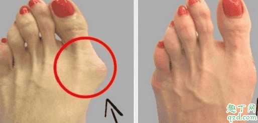 穿高跟鞋会拇外翻吗？拇外翻手术恢复后可以穿高跟鞋吗