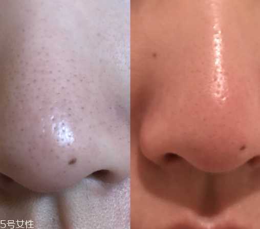 yoii黑头仪有用吗 yoii黑头仪6大功效