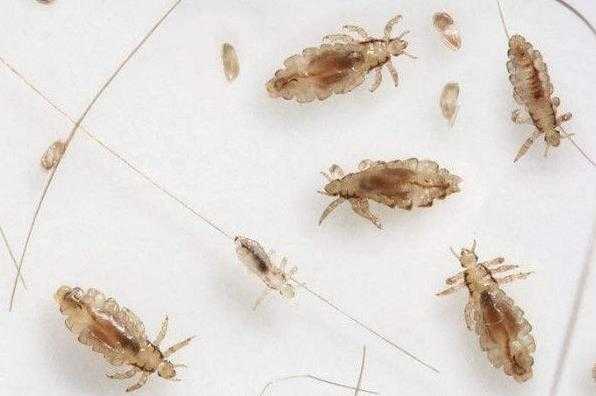虱子的种类有哪些？头上生了虱子怎么去除？