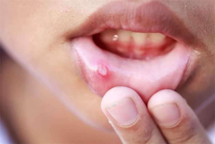 得了口腔溃疡怎么做才能好的快 得了口腔溃疡怎么做才能好的快