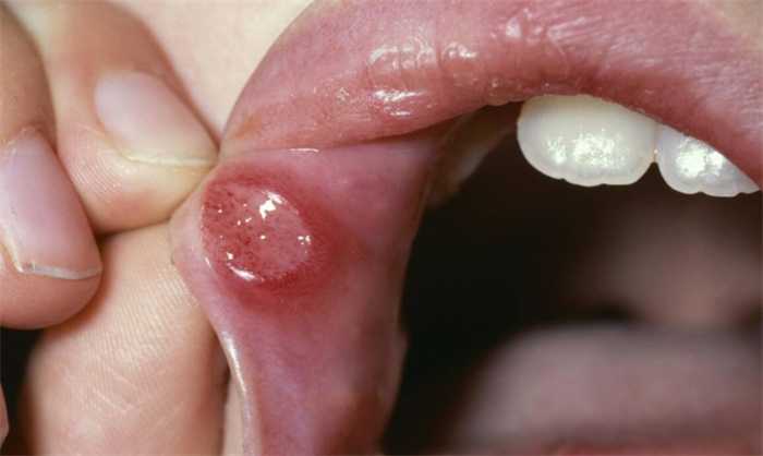 得了口腔溃疡怎么做才能好的快 得了口腔溃疡怎么做才能好的快