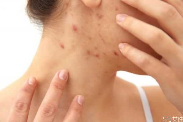 脖子上总是长痘痘是怎么回事？脖子上长痘痘原因