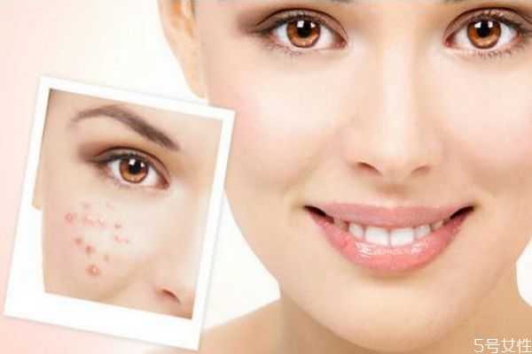 化妆会起痘痘吗?长痘痘到底能不能化妆 化妆会起痘痘吗?长痘痘到底能不能化妆