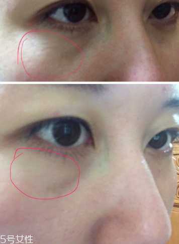 quanis眼膜用法 quanis眼膜用法