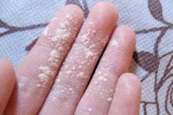 秋冬浮粉怎么办