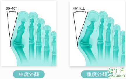 拇外翻矫正器有效果吗？拇外翻矫正器一天带多长时间