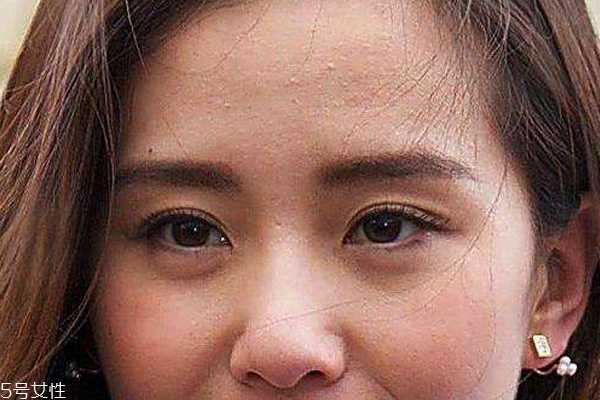 痘痘位置代表哪里不健康