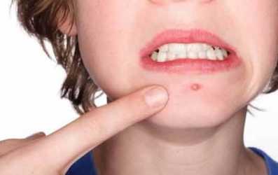 痘痘贴哪个牌子好？痘痘贴贴了有副作用吗