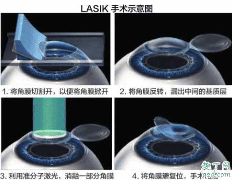 激光近视矫正手术伤眼睛吗 眼睛近视激光会不会有后遗症