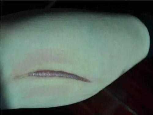 伤口愈合慢是什么原因?为什么伤口愈合慢 伤口愈合慢是什么原因?为什么伤口愈合慢