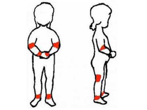 丹毒症状 什么样的症状才是丹毒 丹毒症状 什么样的症状才是丹毒