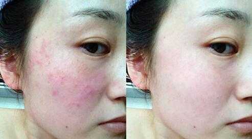 敏感肌怎么判断?敏感肌肤修复方法 敏感肌怎么判断?敏感肌肤修复方法