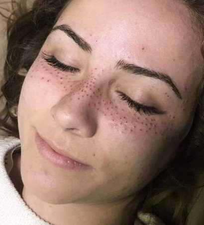 皮秒会不会留疤 皮秒会不会留疤