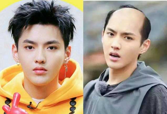 怎么解决发际线后移？发际线后移我们该如何挽救