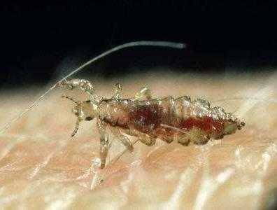 虱子的种类有哪些？头上生了虱子怎么去除？