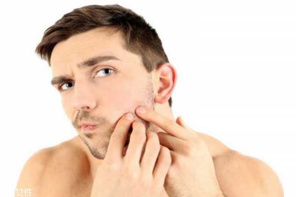 男士要去雀斑吗