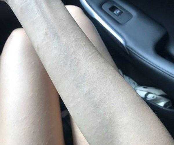 荨麻疹图片和症状 荨麻疹图片和症状