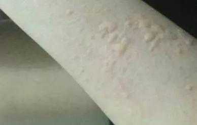 荨麻疹图片和症状 荨麻疹图片和症状