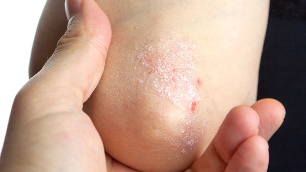 胳膊皮肤粗糙的原因是什么?皮肤粗糙可以吃什么改善? 胳膊皮肤粗糙的原因是什么?皮肤粗糙可以吃什么改善?