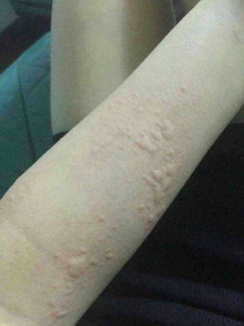 荨麻疹图片和症状 荨麻疹图片和症状