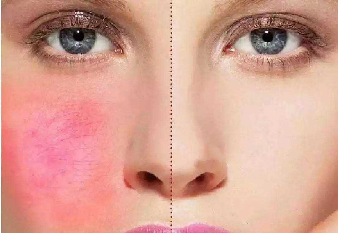 如何预防护肤品过敏?护肤品过敏怎么修复 如何预防护肤品过敏?护肤品过敏怎么修复