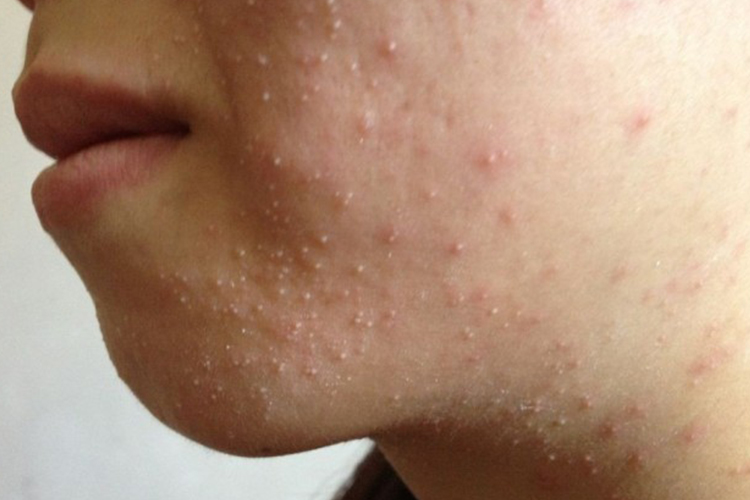 40岁女人下巴总是反复长痘痘怎么办