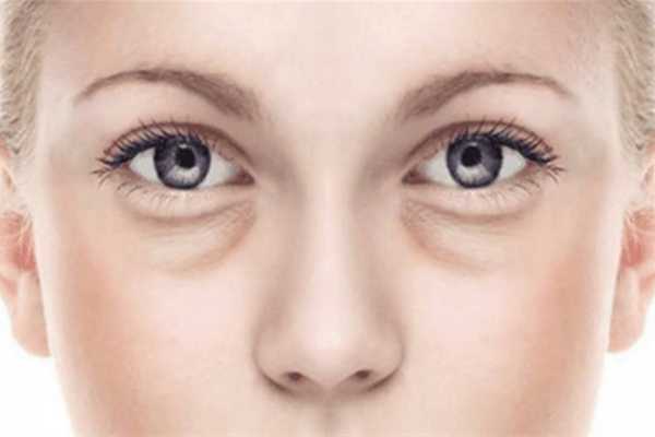 黑眼圈和眼袋有什么区别 黑眼圈和眼袋的区别