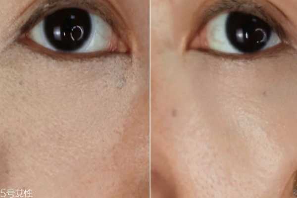 重度泪沟怎么遮瑕