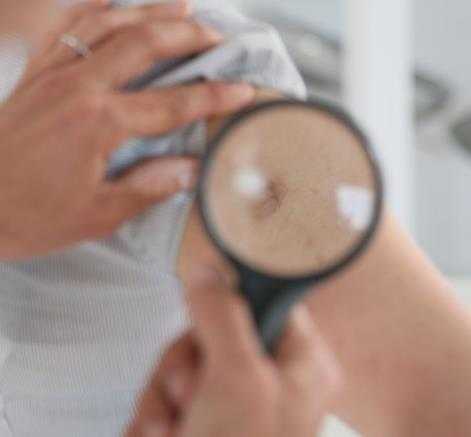 夏季皮炎的原因及症状