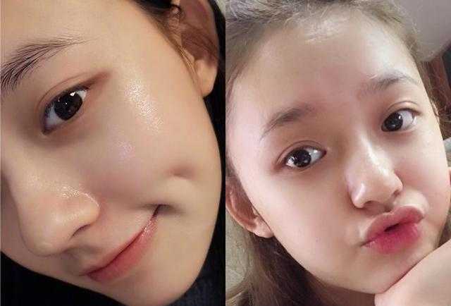 打水光针几天能恢复好？打水光针的好处和坏处