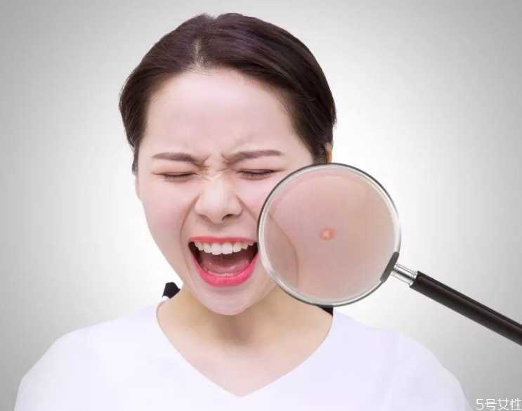 戴口罩长痘痘涂什么药膏？口罩闷痘怎么快速消除