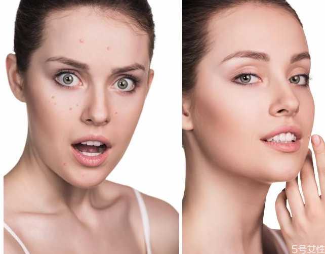 戴口罩长痘痘涂什么药膏？口罩闷痘怎么快速消除