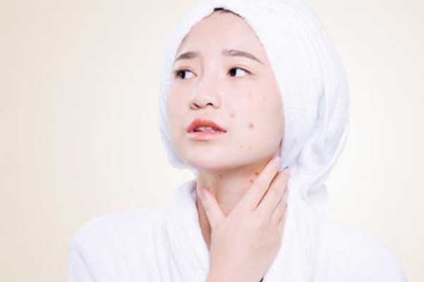 怎么度过水杨酸爆痘期?度过水杨酸爆痘期的方法 怎么度过水杨酸爆痘期?度过水杨酸爆痘期的方法