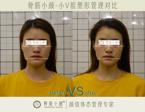 小颜整骨三次就成功了吗 小颜整骨三次就成功了吗