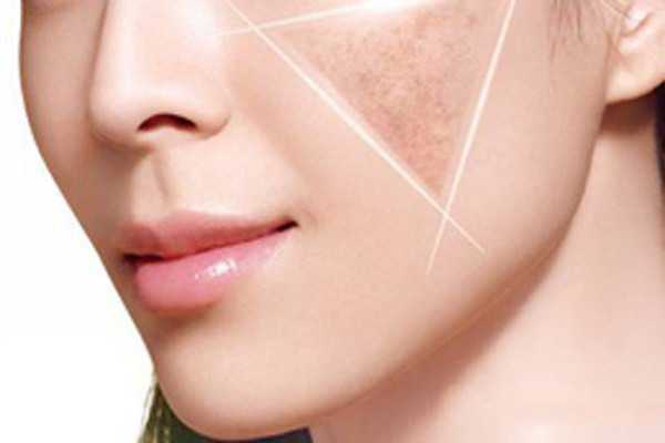 晒斑是如何形成的 晒斑是如何形成的