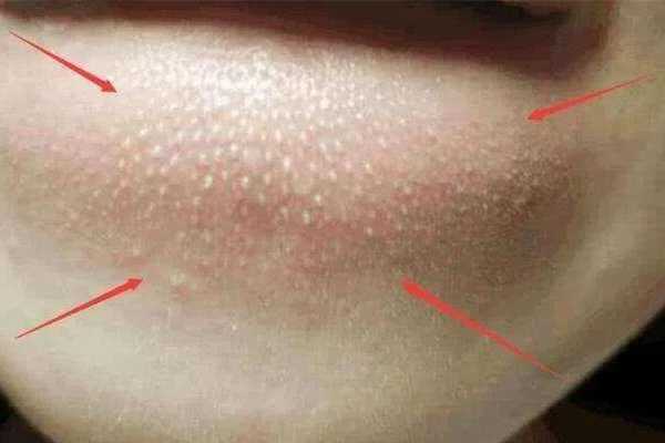 闭口粉刺怎么可以有效去除?闭口粉刺是什么原因引起的 闭口粉刺怎么可以有效去除?闭口粉刺是什么原因引起的