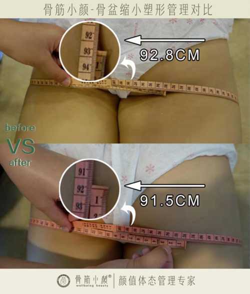 骨筋小颜骨盆缩小管理措施有哪些
